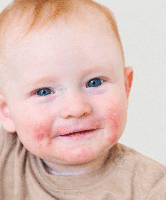 Atopijski dermatitis